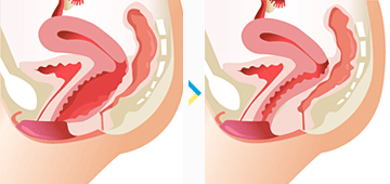 Aesthetic-vaginal-surgery-Tunisia